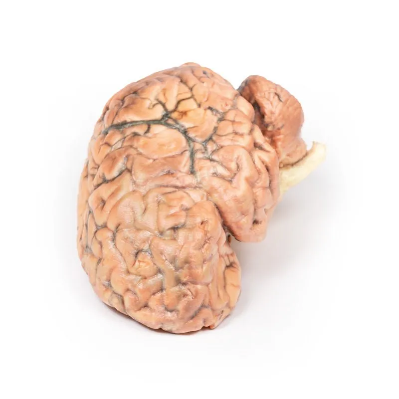 3D Printed Craniopharyngioma
