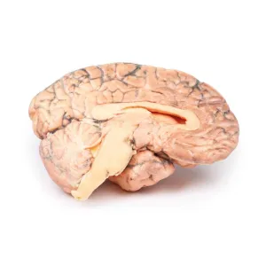 3D Printed Craniopharyngioma