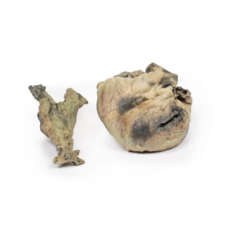 3D Printed Hydatid Disease Affecting the Heart and Aorta