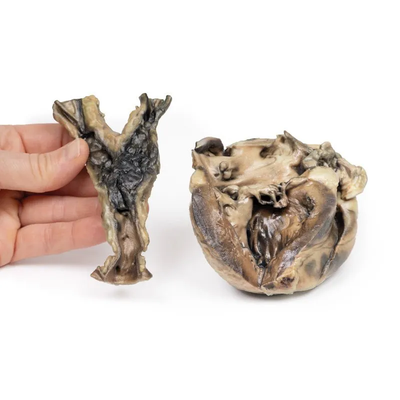 3D Printed Hydatid Disease Affecting the Heart and Aorta