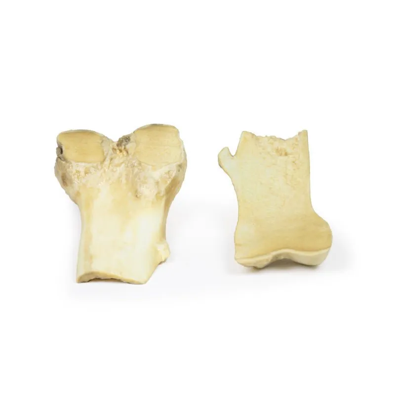Optimized 3D Printed Model of Osteochondroma for Educational Use