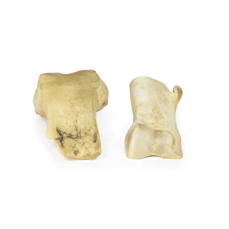 Optimized 3D Printed Model of Osteochondroma for Educational Use